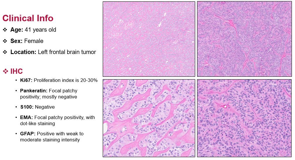 Methylation Case of the Week:

41 year old female patient with a left frontal tumor. GFAP positive and a diagnostic fusion was identified. I hope you have a BLAST figuring this one out. #neuropath #PathTwitter #pathology