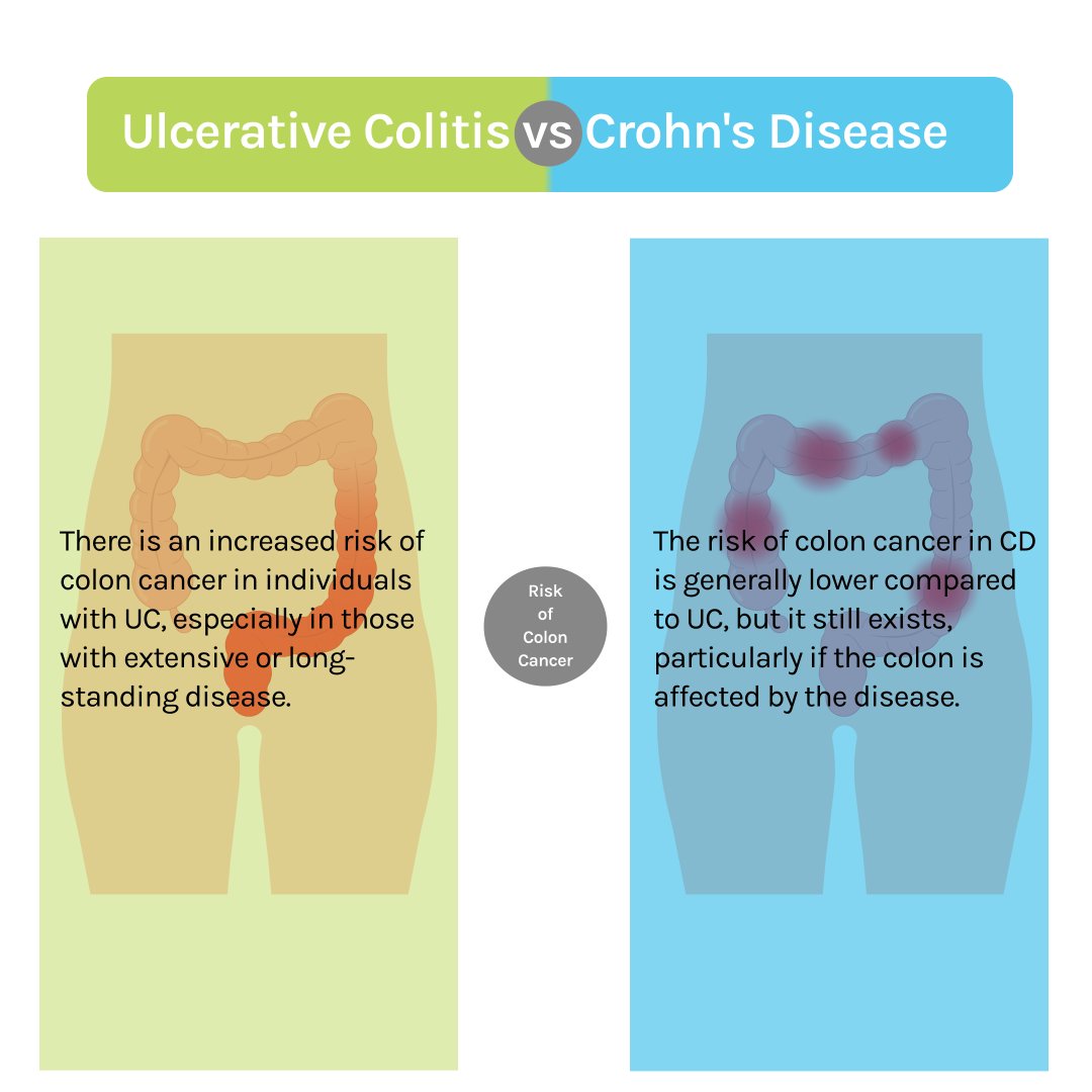 Ulcerative colitis (UC) and Crohn's disease are both types of inflammatory bowel disease (IBD) that are frequently mistaken for one another. Let's explore the key differences between them in this post.

#UlcerativeColitis #CrohnsDisease #Crohns #ESCRS #UAE