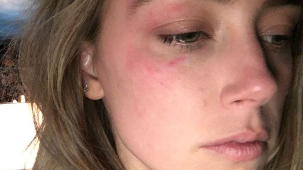 1strongwoman85's tweet photo. #ambuser description of abuse she claims #Depp put her through does match her "injuries" 
She describes a brutal attack. She was drug through glass, repeatedly punched in the face etc etc. All that would have left her bloody and black &amp; blue, and she gave us this. 🙄 https://t.co/yfUmcQfTt4