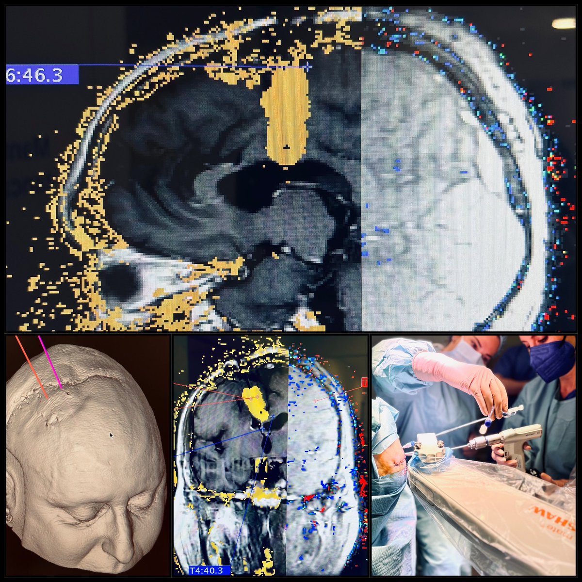 First patient with Brain malignant glioma treated with laser thermal ablation ( LITT) in Spain , <a href="/hospitaldelmar/">Hospital del Mar</a> 
Prehabilitation  with TMS in <a href="/IGuttmann/">INSTITUT GUTTMANN</a> 
N.Infante ,<a href="/SusanaPacreu/">susana pacreu</a> 
J.Capellades 
<a href="/kierkegaard91/">Kilian Abellaneda</a> , A. Roca , S.delgado , E. Buloz