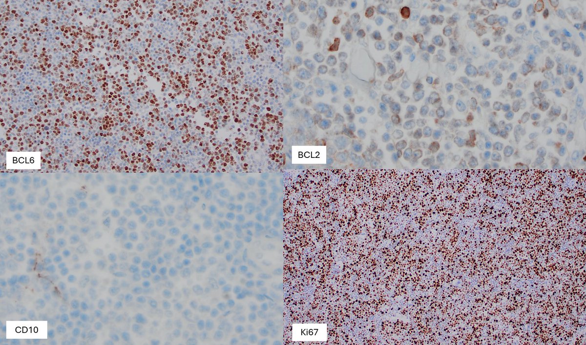 Relapsed primary cutaneous follicle-center lymphoma in the lower extremity:
🩸PCFCL presenting on the leg has a less favorable prognosis 
🩸Relapses are observed in about 30% of patients, and do not necessarily indicate progressive disease 
#hemepath #lymsm #pathtwitter #dermpath