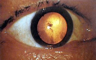 Photograph of a victim's eyeball after bombing of Hiroshima with an 'atomic bomb' cataract, 1945.