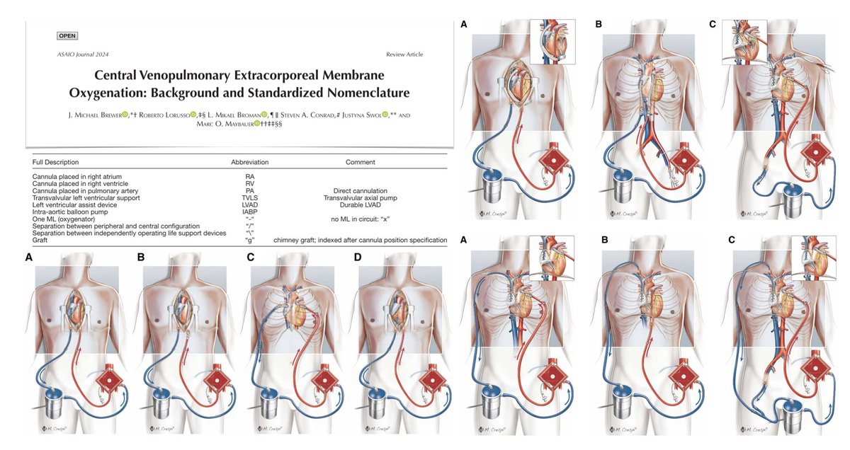 🫀🫁 Central venopulmonary #ECMO:
➡️central PA access for #ECLS 
➡️standardized nomenclature & abbreviations for central PA access
➡️combined central/peripheral configurations
➡️combination with independent devices
#FOAMcc #FOAMecmo on @asaiojournal  
🔓 bit.ly/4bpjlTH