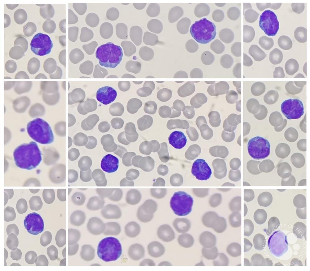 T-cell prolymphocytic leukemia (T-PLL) | ASH Image Bank | American Society of Hematology imagebank.hematology.org/image/64966/tc… #ASHImageBank