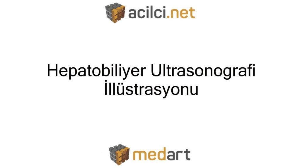 Arşivden: Hepatobiliyer Ultrasonografi İllüstrasyonu Murat Yazıcı @acilci_net için yazdı: buff.ly/3n66cbh #FOAMed #hepatobiliyer #MedArt #USG