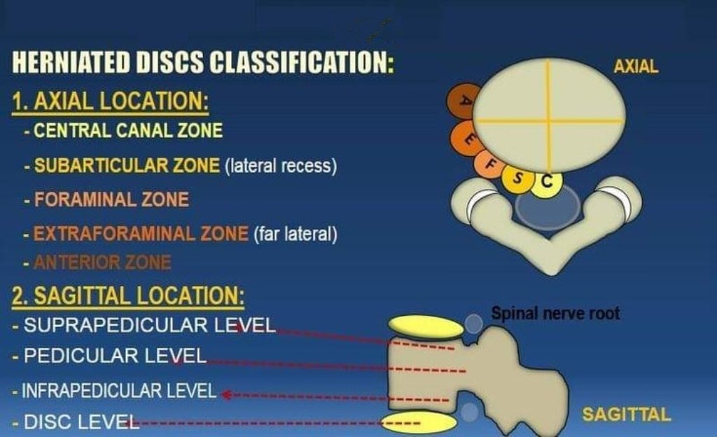 Herniated disc location : Axial vs Sagittal m.facebook.com/FRCRRGP/photos…