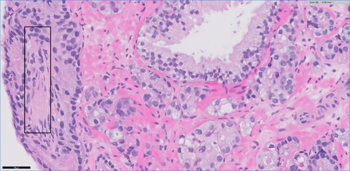 #GUpath challenges in prostate bx grading:

🔬when prostate cancer engulfs a nerve (rectangle), many times this can mimic pattern 4...

3+3?
3+focal 4?

perhaps no right answer   #grayzonepath