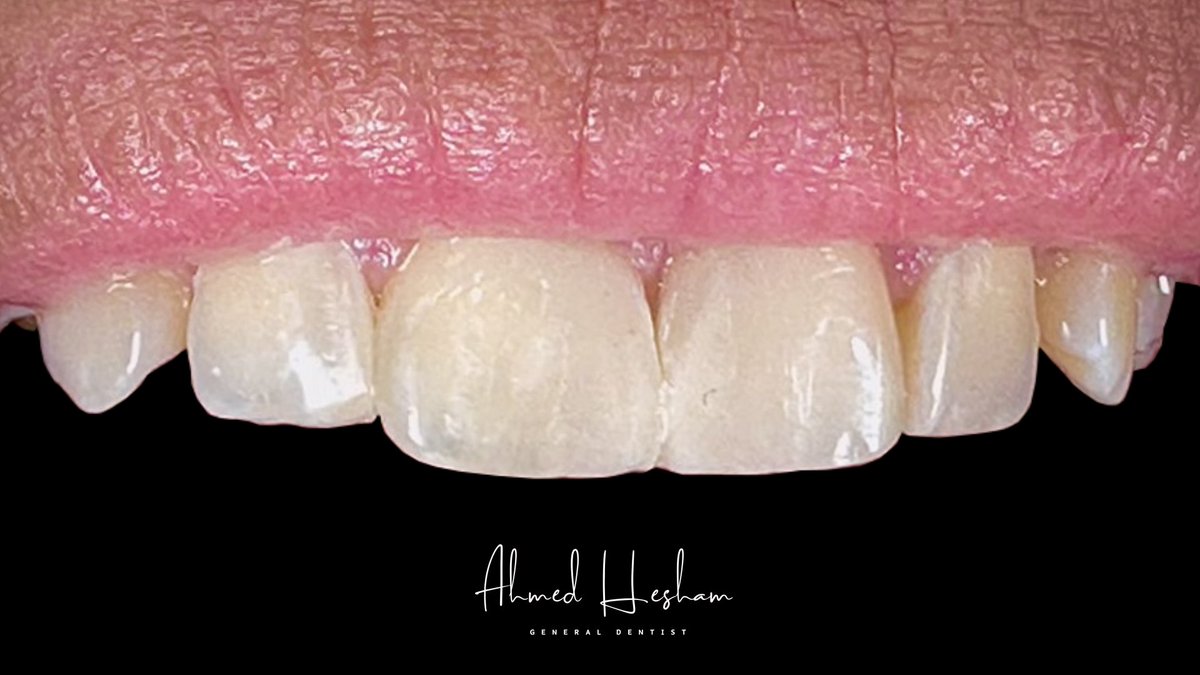 AhmedHi45307923's tweet photo. multiple diastema closure ♥️ https://t.co/tXGATBAa2C