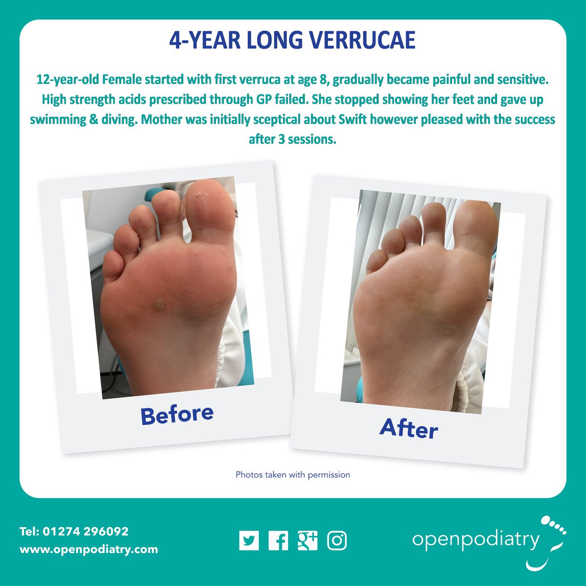 OpenPodiatry's tweet photo. Check out these 3 recent success stories with fantastic results against verrucas using Swift.
Contact us .
@swift_treatment
#Podiatry #feet #Bradford #footpain #verruca #openpodiatry #nails #wartremoval #treatedverruca #swifttreatment #verrucatreatment #bradfordpodiatrist https://t.co/JhGfMmCs1U