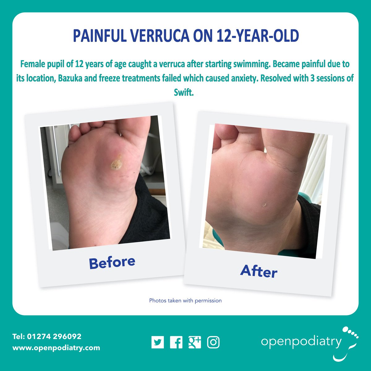 Check out these 3 recent success stories with fantastic results against verrucas using Swift. 
Contact us .

@swift_treatment 

#Podiatry #feet #Bradford #footpain #verruca  #openpodiatry #nails #wartremoval #treatedverruca #swifttreatment #verrucatreatment #bradfordpodiatrist