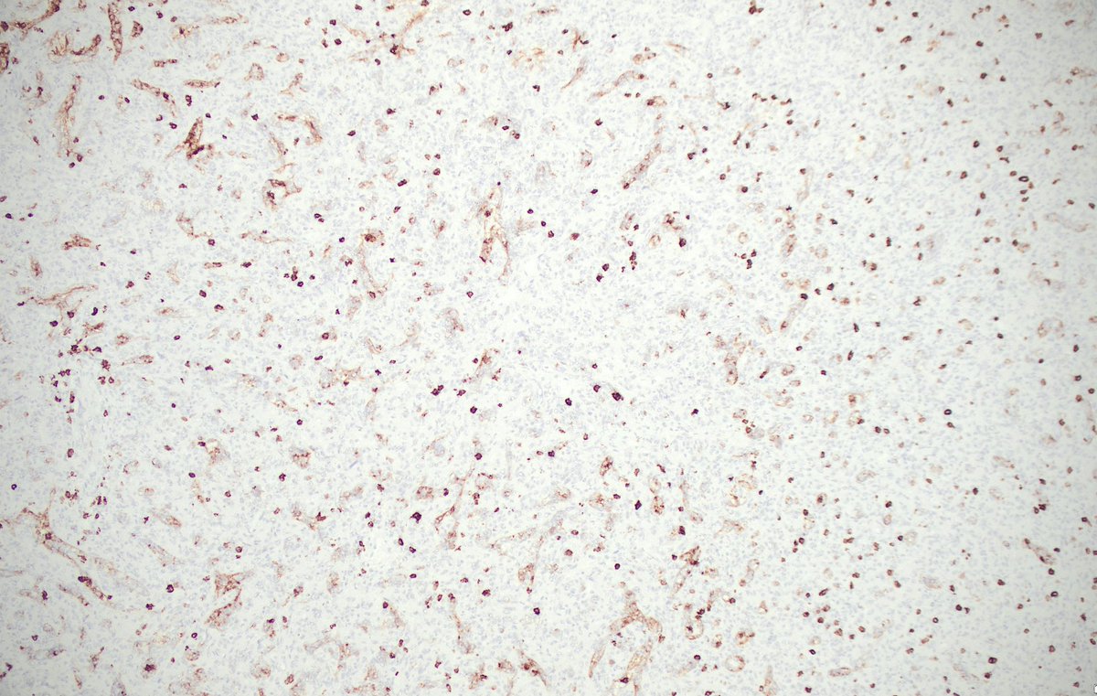 Brooj Abro, MD tweet media