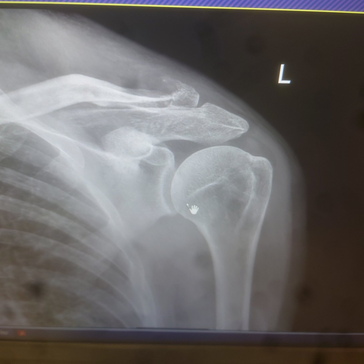 ConnollySevey's tweet photo. @Hickyparma @_benacurtis @FaucheuxRacing Get well soon @_benacurtis I've got a broken collar bone as well! https://t.co/ymnxJDnyjp