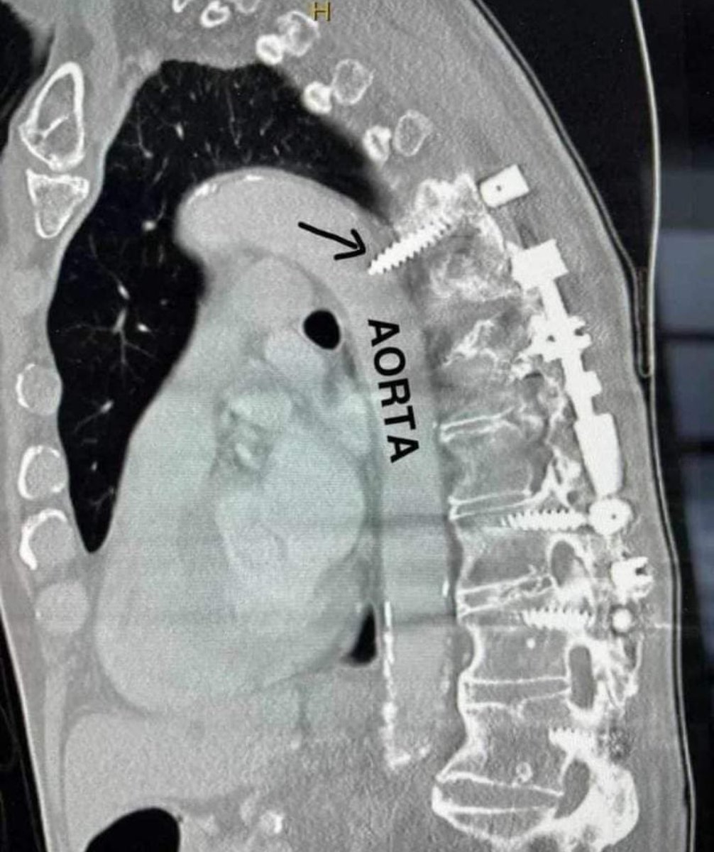 A rare complication of spinal surgery 😬