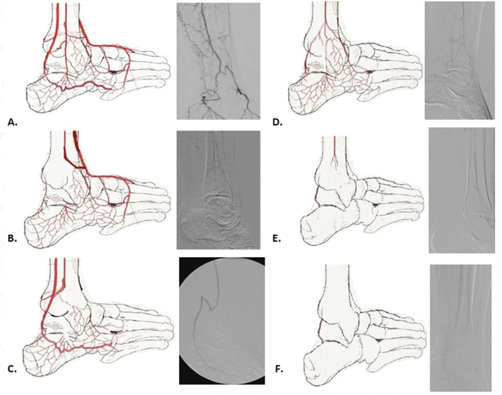 UMiami Vascular Surgery (@umvascular) on Twitter photo JVS: Blind Peroneal Artery Outflow Bypass for Limb Salvage in Patients With Severe CLTI.
<a href="/VascularSVS/">Society for Vascular Surgery</a> #VAM24
jvascsurg.org/article/S0741-… JVS: Blind Peroneal Artery Outflow Bypass for Limb Salvage in Patients With Severe CLTI.
<a href="/VascularSVS/">Society for Vascular Surgery</a> #VAM24
jvascsurg.org/article/S0741-…