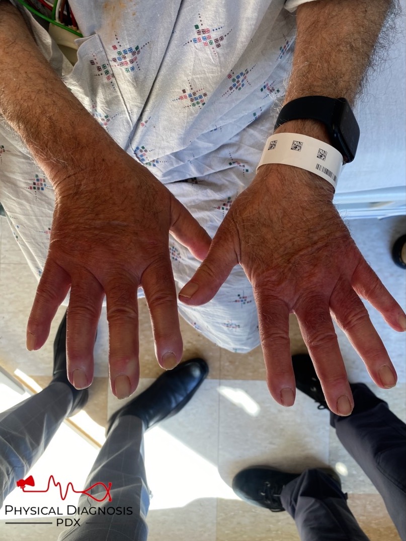 1/10
A 76 y/o man presents with swallowing difficulty.

So why are we looking at his hands?