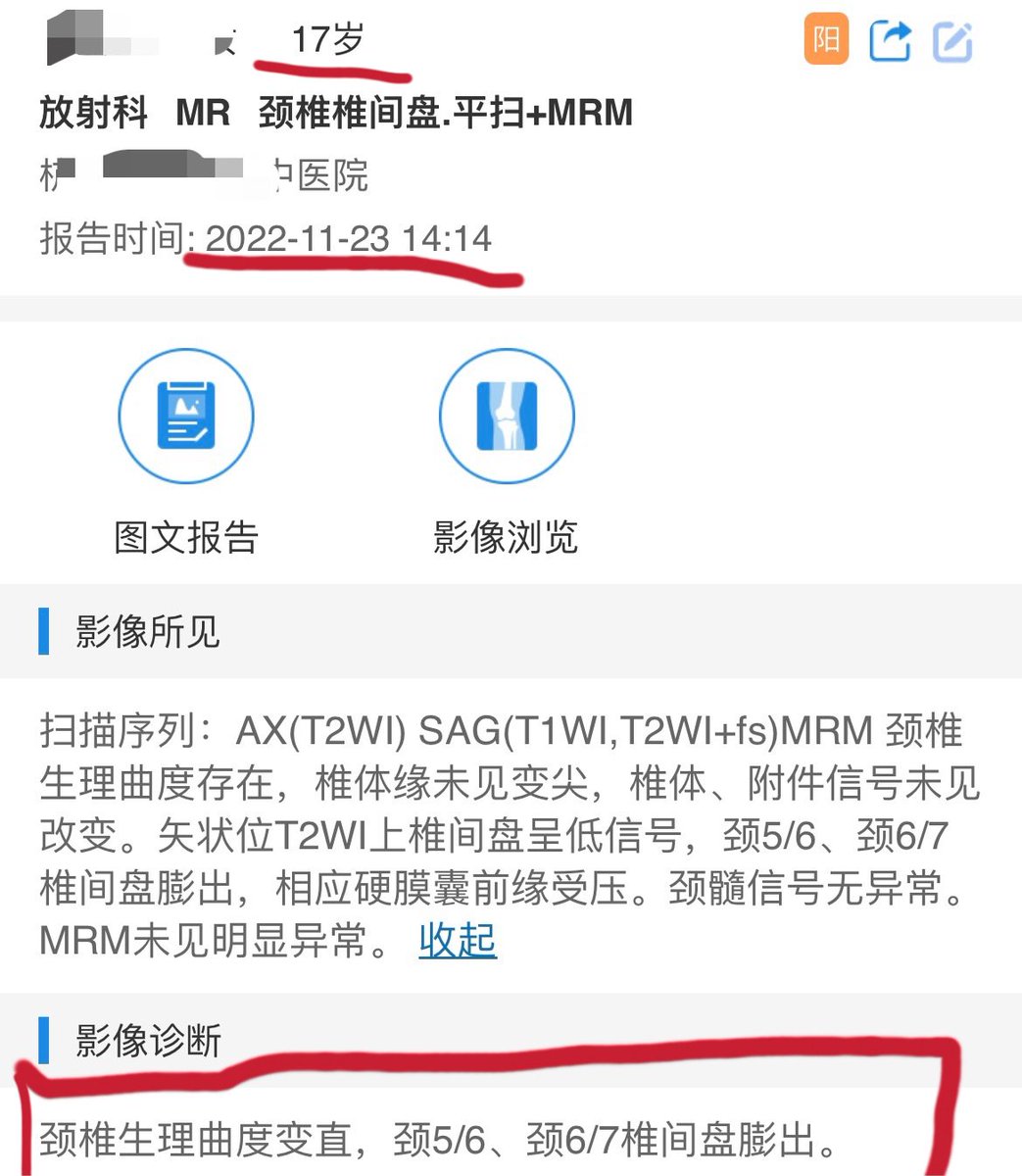 Vicious9382's tweet photo. 这是我腰椎病和颈椎病的证据，统称为脊椎病。除了图上显示的椎间盘突出，还有髓核水分流失，退行性改变，腰椎侧弯，脊椎侧弯，腰椎轻度骨质增生，腰椎曲度稍直。和颈椎曲度变直。现在我���天都肩颈头痛，腰痛。弯腰和低头一会就会痛，也不能坐着超过五分钟，就会痛。 https://t.co/u3D0l28OYE