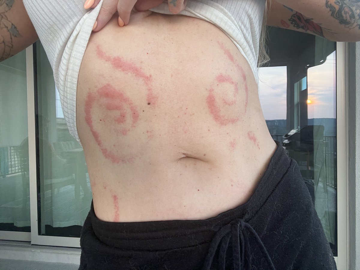 i had an allergic reaction to something in the rhinestone adhesive i used on one of my cosplays for the weekend and now i have contact dermatitis swirls all over my torso lmfao. itchy as hell but looks kinda cool