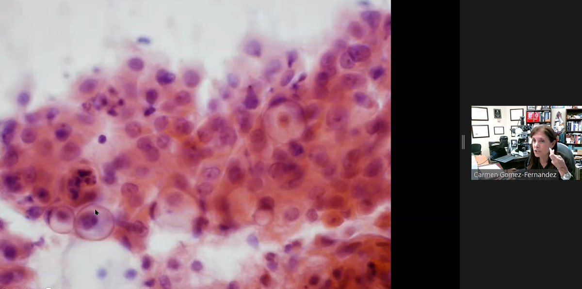 Great cases .... Pleomorphic adenoma, Adenoid cystic adenocarcinoma and Mucoepidermoid carcinoma... @UMiamiPathology @CarmenGomezMD @martin_poveda82 @Silvia_HdzMD @Citopatoroxx @asocolpat #citologia #cytology