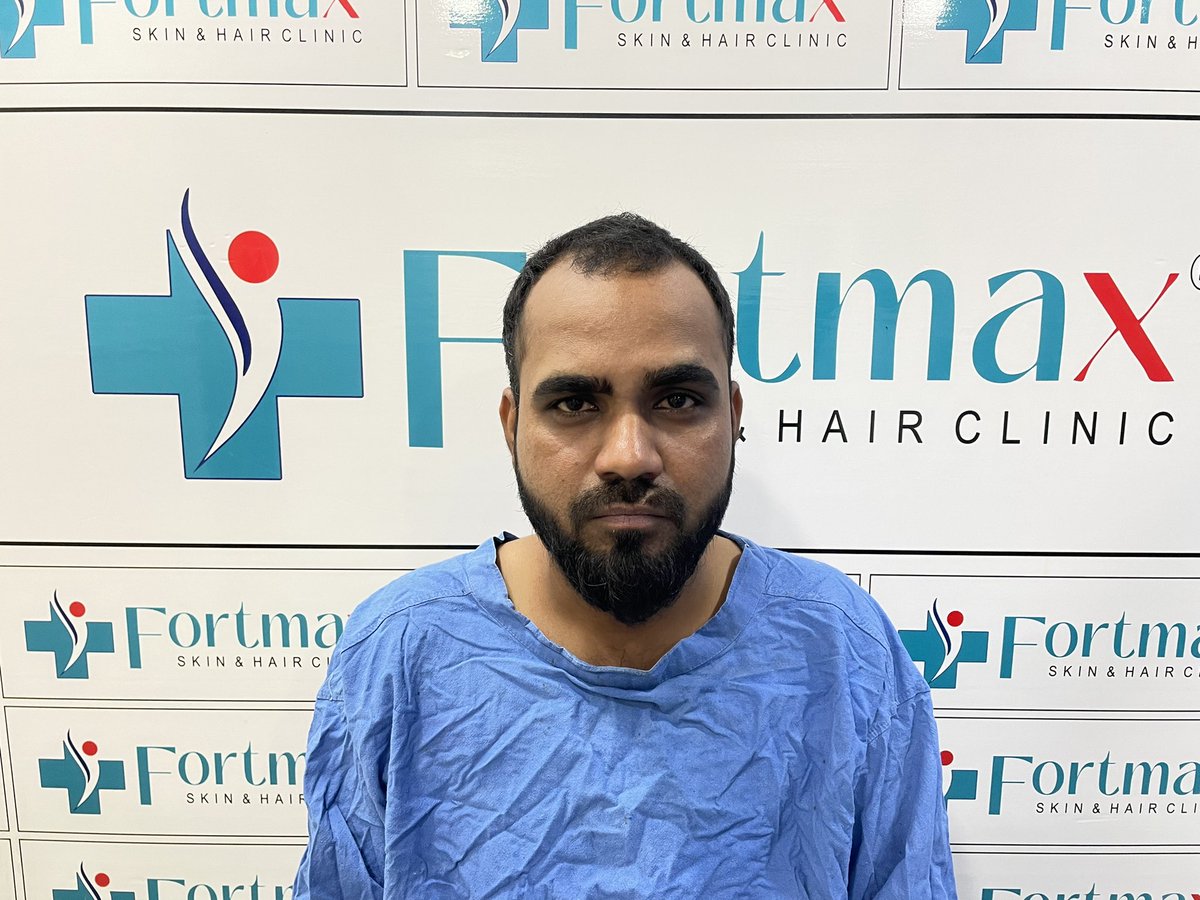 Sanjay  #Bhilwara #Rajasthan #HairTransplant at our #jaipur centre on 20/05/2024 with FUE & DHI technique (4500 graft )
#HairTransplant #HairRestoration #HairLossSolution #ConfidenceBoost #EMIOffer #HairRevival #NewYou #HairTransformation #SelfAssurance #HairCare #BeConfident