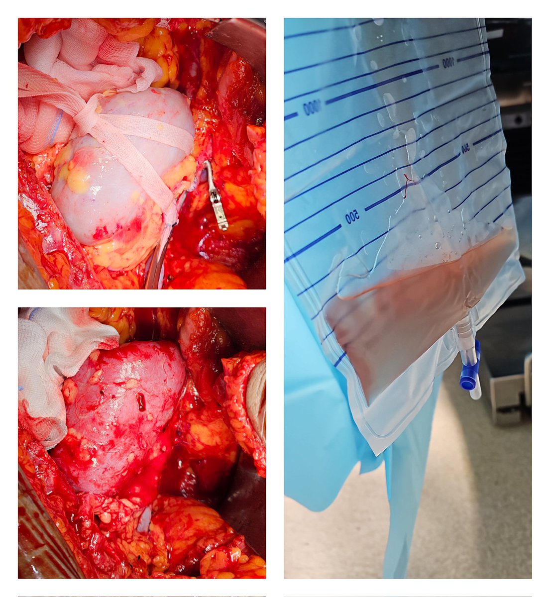 dr_dublin's tweet photo. It never cease to excite me seeing that.....
#renaltransplant https://t.co/GqUHFV5l7X