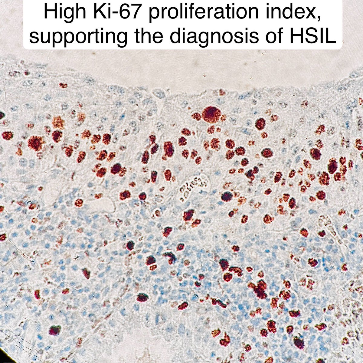 HSIL • Nucleoli can be tricky because it can be seen in reactive conditions. • But sometimes they can be seen in HSIL esp when it involves endocervical glands #pathagonia #pathx #path4people #gynpath #obgyn #hpv #hsil #pathtwitter #pathology #gynx #obgynx #surgpath #medx