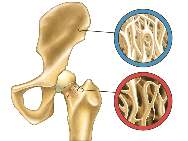 Osteopenia is the medical definition for having reduced bone density. Osteopenia is the warning sign that means it  increased osteoporosis and fracture risk.
#osteopenia #bone #density #fracture