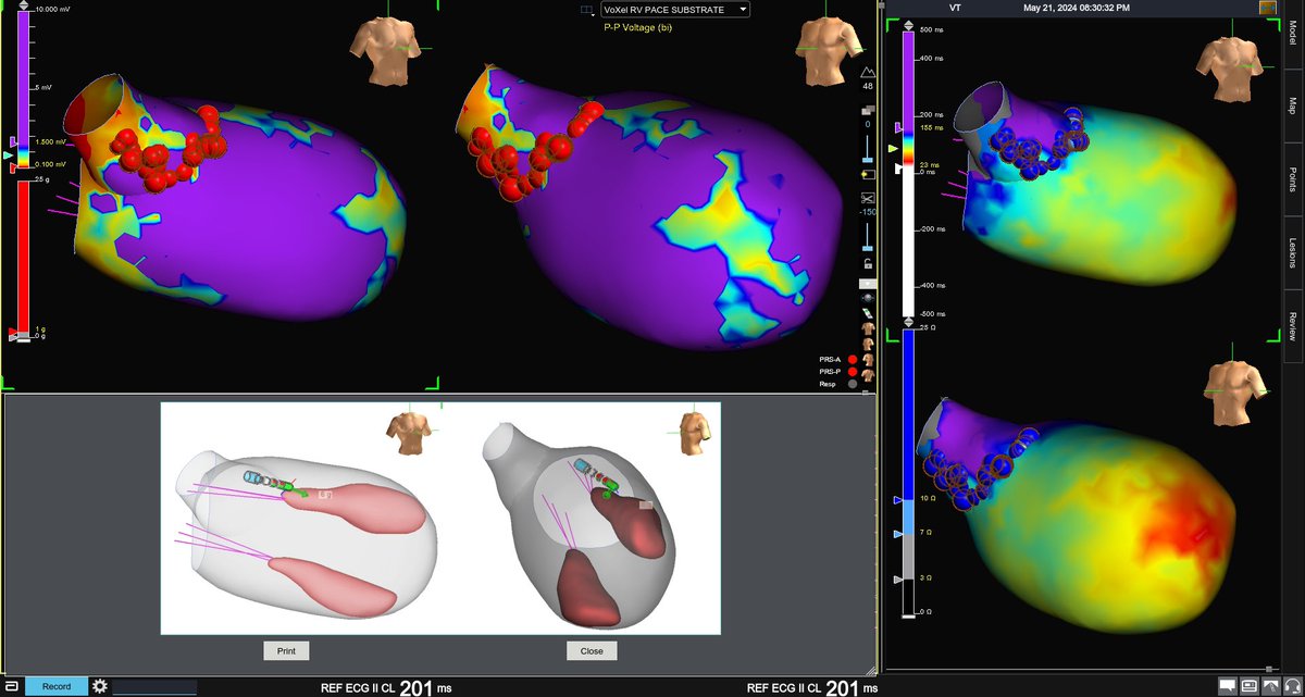 Edward Cheng, MD, PhD (@drepcheng) on Twitter photo Substrate/decel zone based VT ablation in LVOT/ anterior septum in mixed CM correlating with exit of clinical VT Pt with preéxisting CHB so His/LB not an issue. Transeptal access due to comorbid PAD. Non indicible Excellent mapping <a href="/georgecrowell/">George Crowell</a> #EPeeps Substrate/decel zone based VT ablation in LVOT/ anterior septum in mixed CM correlating with exit of clinical VT Pt with preéxisting CHB so His/LB not an issue. Transeptal access due to comorbid PAD. Non indicible Excellent mapping <a href="/georgecrowell/">George Crowell</a> #EPeeps