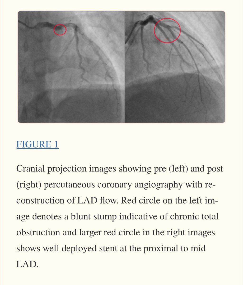 Coronary angiography showed chronic total obstruction of 2 coronary arteries.