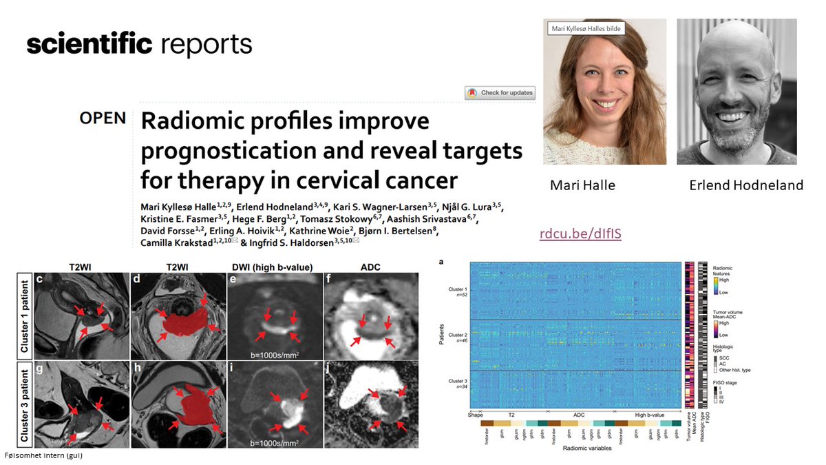 Ingfrid Haldorsen (@ingfridhaldors1) on Twitter photo Radiomic profiles predict outcome in #uterine #cervicalcancer and reveal targets for therapy! rdcu.be/dIfIS. Contrats to <a href="/KyllesMari/">Mari Kyllesø Halle</a> and Erlend Hodneland <a href="/BergenMMIV/">MMIV</a> et al. publishing in Scientific Reports: rdcu.be/dIfIS. <a href="/SciReports/">Scientific Reports</a> @mohnfoundation <a href="/UiB/">Universitetet i Bergen</a> Radiomic profiles predict outcome in #uterine #cervicalcancer and reveal targets for therapy! rdcu.be/dIfIS. Contrats to <a href="/KyllesMari/">Mari Kyllesø Halle</a> and Erlend Hodneland <a href="/BergenMMIV/">MMIV</a> et al. publishing in Scientific Reports: rdcu.be/dIfIS. <a href="/SciReports/">Scientific Reports</a> @mohnfoundation <a href="/UiB/">Universitetet i Bergen</a>