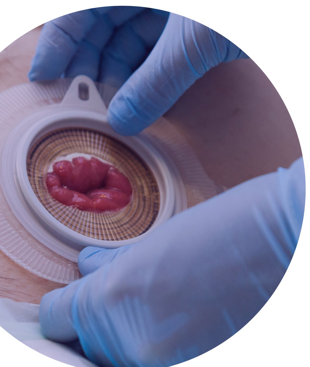 @ACPGBI (@acpgbi) on Twitter photo Join the EGS Sub-Committee for a webinar on 'Stomas in the Emergency Room' on 3 June.
Real cases and expert panel discussions - don't miss out!
#EmergencySurgery #StomaManagement
👉bit.ly/ACP-Stomas-in-…
<a href="/slade_dom/">Dominic Slade</a>
<a href="/Richard_J_Guy/">Richard Guy</a> Join the EGS Sub-Committee for a webinar on 'Stomas in the Emergency Room' on 3 June.
Real cases and expert panel discussions - don't miss out!
#EmergencySurgery #StomaManagement
👉bit.ly/ACP-Stomas-in-…
<a href="/slade_dom/">Dominic Slade</a>
<a href="/Richard_J_Guy/">Richard Guy</a>