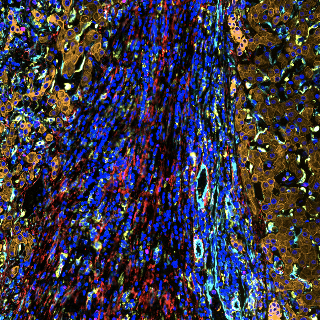 Dive into the complexity of TME with our open multiplexing solution! Using #CellDIVE @CellSignal antibodies, and #Aivia we unveil tissue-specific and shared spatial interactions across diverse cancers, advancing our understanding of disease progression. 👉 fcld.ly/jtoy0b1