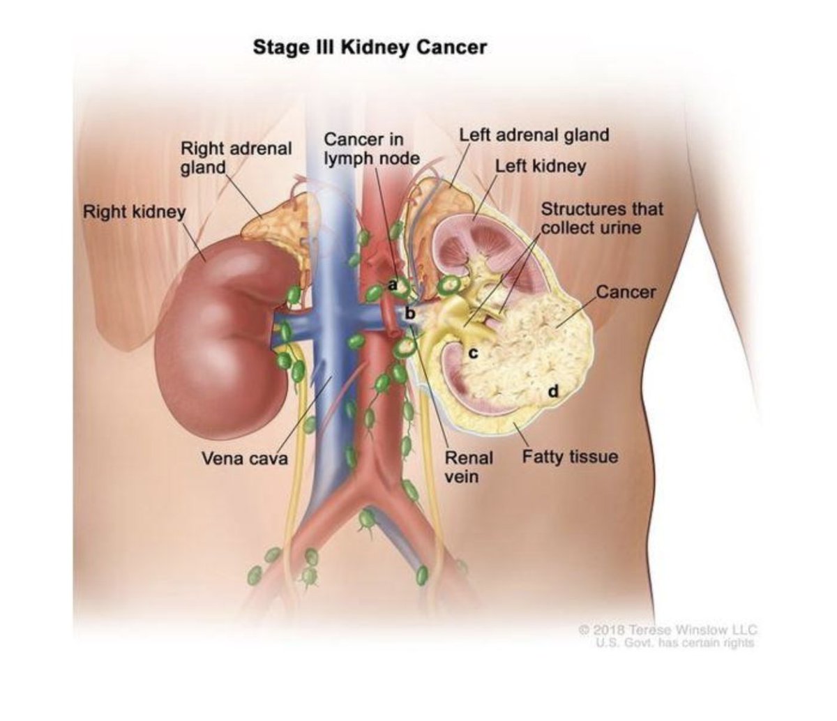 📣 CANCER CURRENTS: Dr. Mark Ball, an attending surgeon in our Urologic Oncology Branch, weighed in on results from a #ClinicalTrial that show survival improvement for #KidneyCancer patients treated with Pembrolizumab. 

➡️ cancer.gov/news-events/ca…