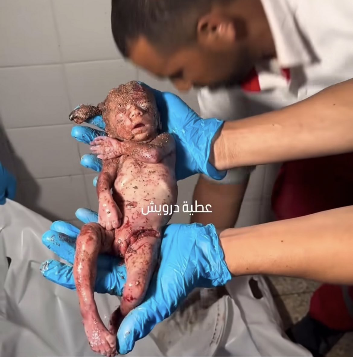 Pilein1's tweet photo. Just happended in Gaza- Palestine!
The fetus was martyred in his mother's womb!!! 

#Palästina 
#GenocideBylsrael 
#PalestinaNoEstáSola https://t.co/4Aakx4uANl