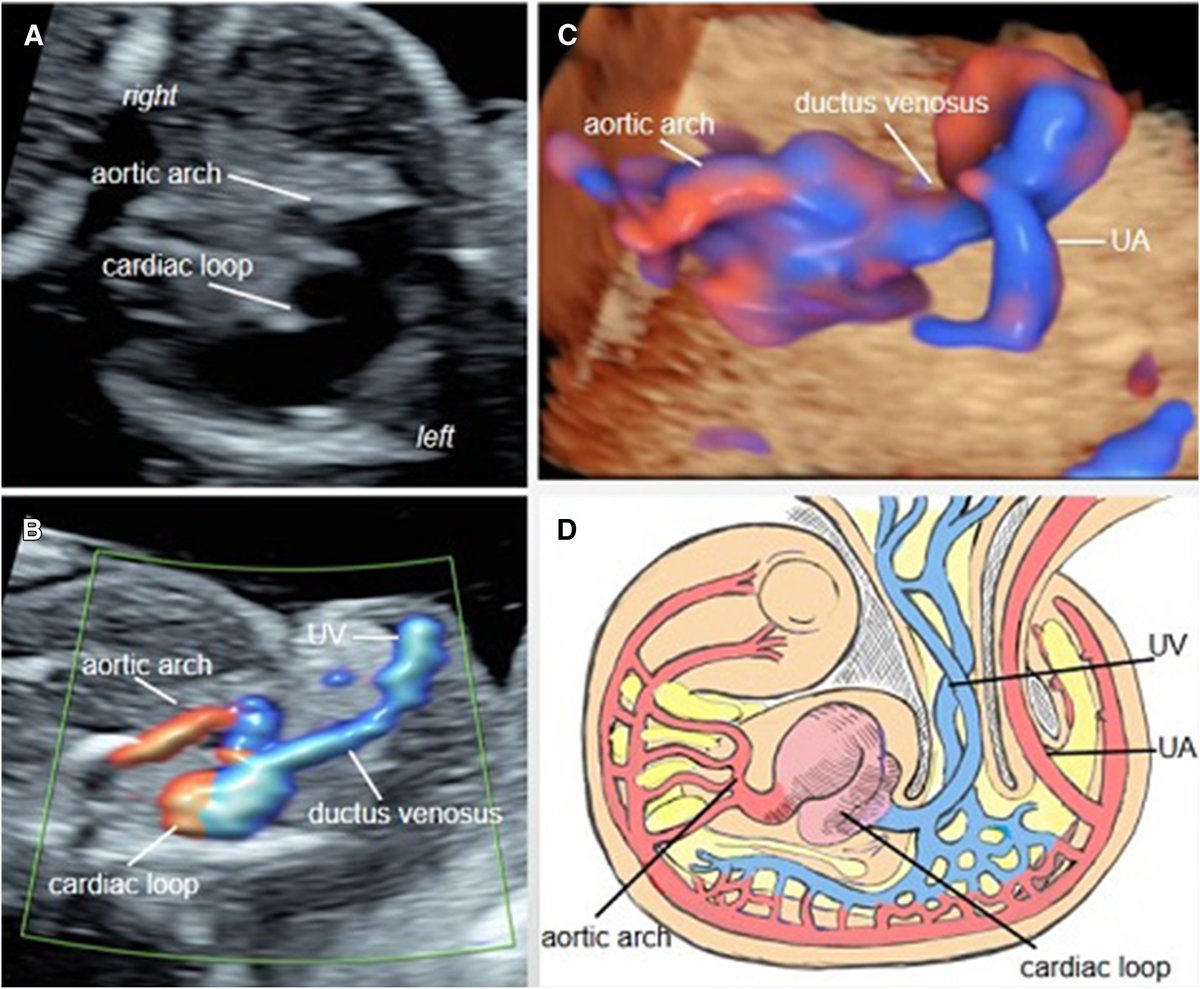 Images in Obstetrics: Twin reversed arterial perfusion sequence with a cardiac loop - A–C, Sonographic views of the reversed acardiac circulation in the cardiac loop. D, Schematic diagram of the embryo development of the cardiac loop ow.ly/nPkM50PSjPS