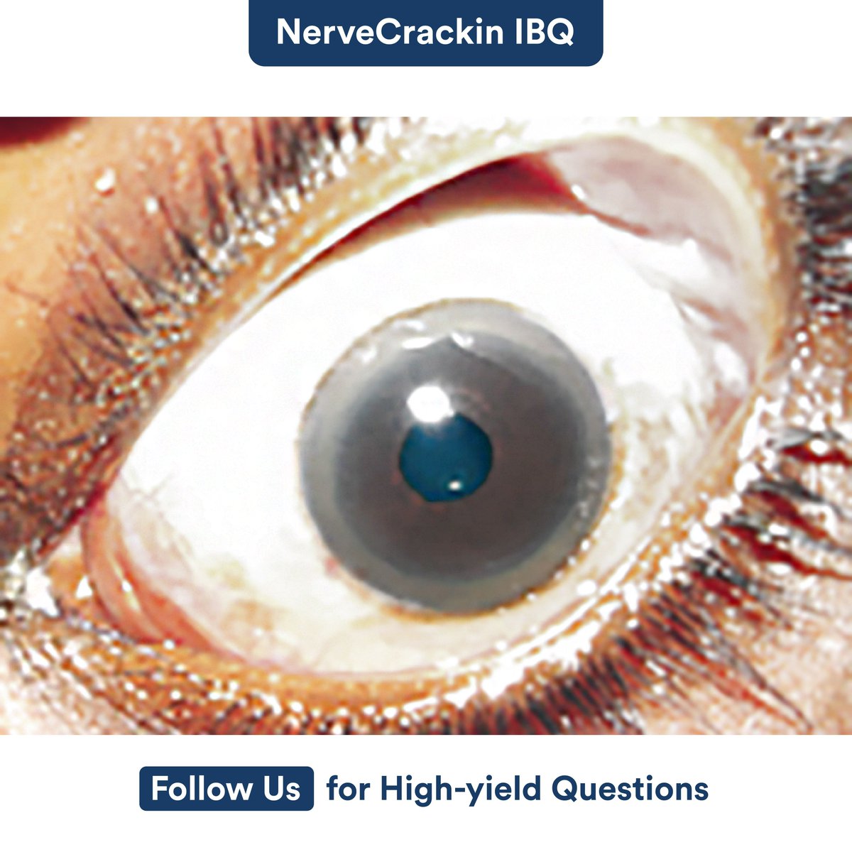 Which disease has been shown in this image?

A. Arcus senilis
B. Glaucoma
C. Kayser-Fleischer rings showing Wilson’s disease
D. Conjunctivitis

#DigiNerve #IBQ #NerveCrackin #QuizTime #Arcussenilis #Glaucoma #KayserFleischerringsshowingWilsonsdisease #Conjunctivitis