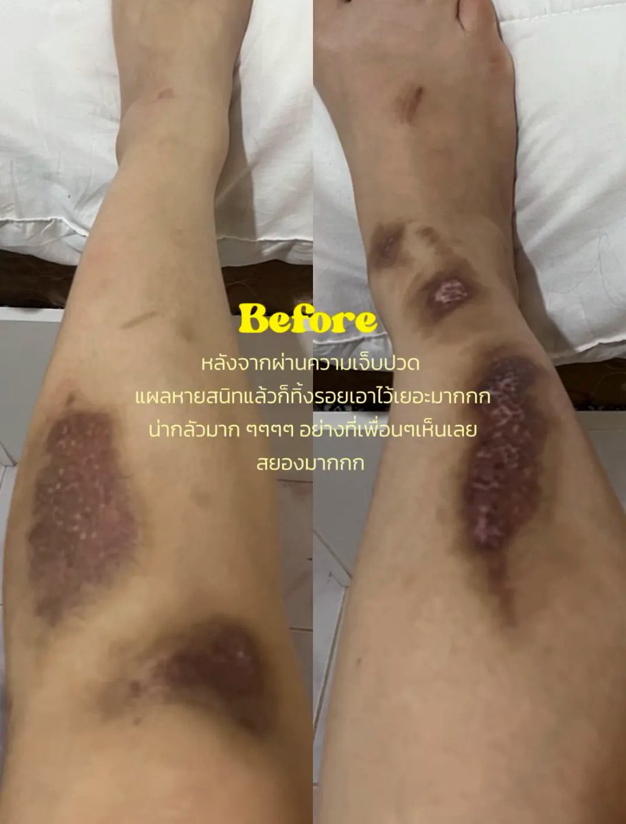 marinths's tweet photo. สำหรับเราคือดีเกินคาดค่ะ เพราะส่วนตัวเราค่อนข้างเป็นคนขี้เกียจทาครีมหรือโลชั่นบำรุงผิว ทำให้เราความถี่ของการทาน้อยมาก แต่ได้ขนาดนี้ก็คือจึ้งมากแล้ววว  ใช้มา 1 ปีนิดๆ ปล.ไม่เคยเลเซอร์รอยแผลเป็นเลยค่ะ ใช้แค่ Bio-oil + โลชั่นบำรุงผิวทั่วไป  🛒 พิกัด : https://t.co/x8vXUrYcN5 https://t.co/IVVKt8Nfyj
