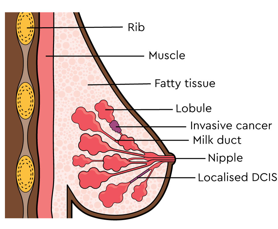 JofCancerPrev's tweet photo. Ductal carcinoma in situ is the presence of abnormal cells inside a milk duct in the breast. DCIS is considered the earliest form of breast cancer. DCIS is noninvasive meaning it hasn't spread out of the milk duct and has a low risk of becoming invasive
#ductal #carcinoma #cells https://t.co/wv0x4mjkbs