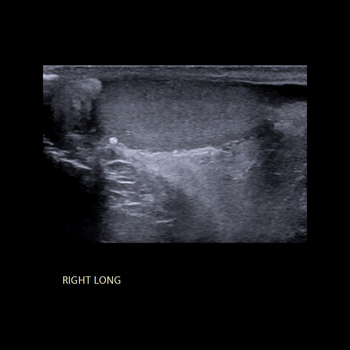 Teen with right scrotal fullness

Sagittal US of right scrotum shows round echogenic extratesticular lesion that does not have posterior shadowing in superior+posterior scrotum

The diagnosis was scrotolith

#FOAMed #MedEd #FOAMPed #FOAMRad #PedsRad #FOAMus #USRad #Ultrasound