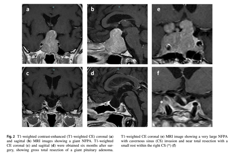 💢Our article in Acta Neurochirurgica

📌Clinical presentation and surgical outcomes of very large and giant pituitary adenomas: 80 cases in a cohort study of 306 patients with pituitary adenomas

👉Giant PA have <resection rates and >postQx complications 
link.springer.com/article/10.100…