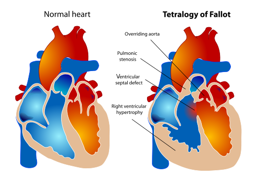 Tetralogy of Fallot:
1.   Ventricular septal defect, 
2.  Overriding aorta, 
3.  Pulmonary stenosis and
4.   Right ventricular hypertrophy.