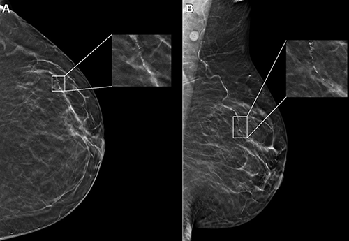 Race, Age Impact AI Performance on Digital Mammograms Learn more ➡️ bit.ly/44Tw7aT @radiology_rsna @DerekLNguyen @DukeRadiology #RadNews #AI #DigitalMammo #Mammography #Mammo #BreastImaging