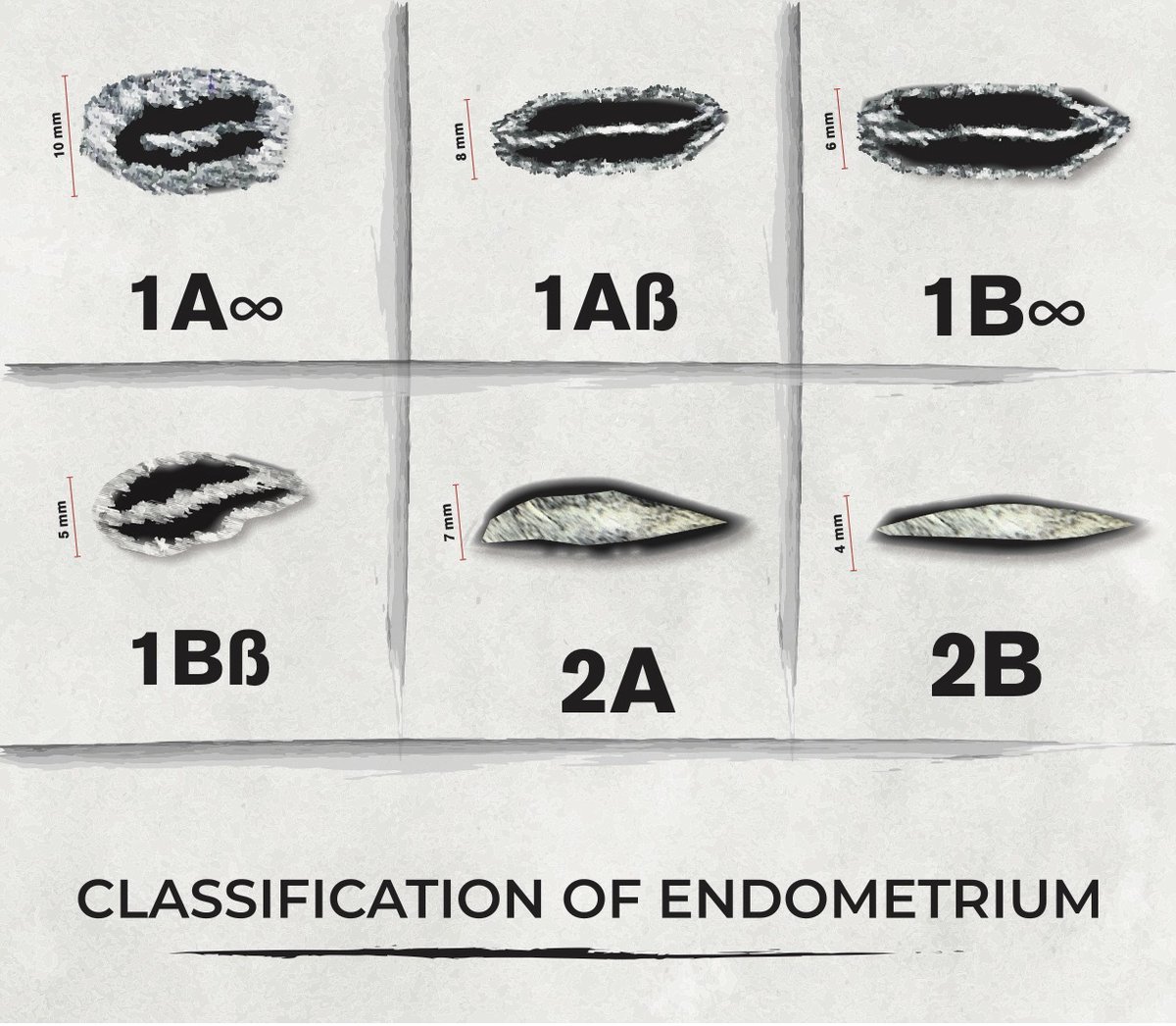 ITBusinessCompa's tweet image. Ultrasonographic endometrial classification in In Vitro Fertilization: a new approach
doi.org/10.46989/001c.…
#endometrium #artificiallyinteligence #fertility #endometriumreceptivity #IVF #assistedreproduction