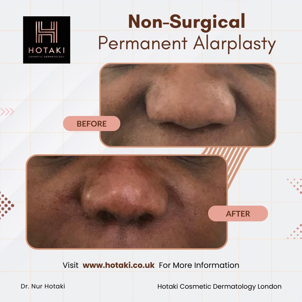 #drhotaki #hotakilondon #nonsurgicalaesthetics #aesthetictreatment #hotakicosmeticdermatology #noninvasive #nonsurgical #nonsurgicalpermanentalarplasty #nonsurgicalalarplasty #alarplasty