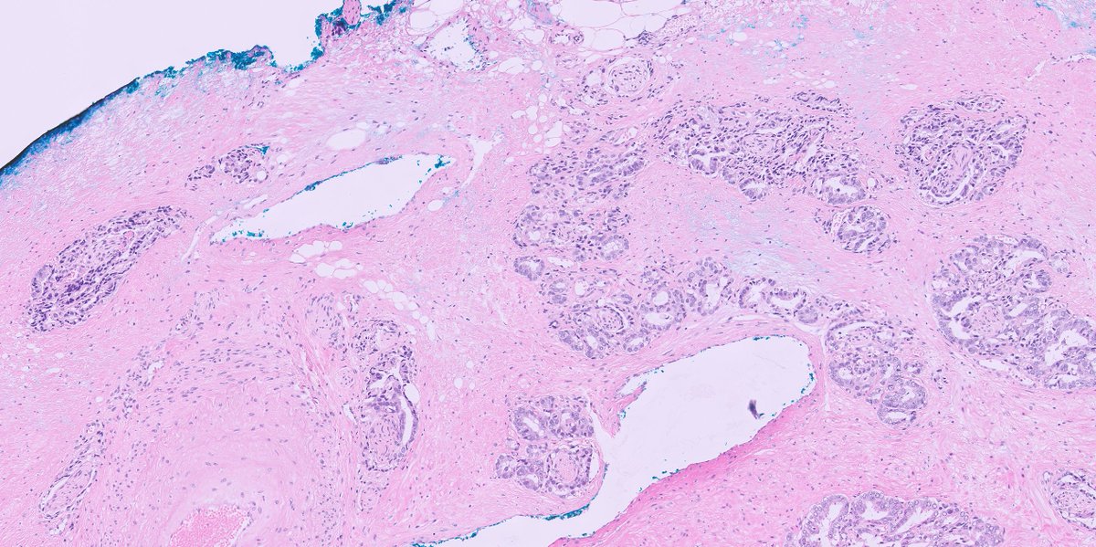 1/ A classical #GUpath question: EPE or not EPE? 😂 Sagital section from the base of the prostate 👇👇 The normal glands are encircled with yellow marking. Poll in the thread below ... #pathology #pathtwitter