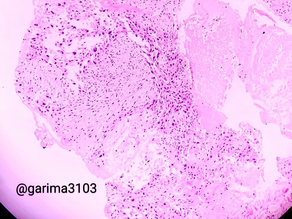 Lets do some mind scratching 
Elderly female with cervical nodal mass UE
#pathtwitter #pathology #pathresidents #headandneckpath 
Opinions please 🔬🫴