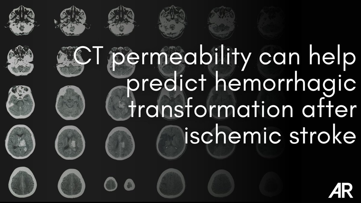 “Development of an extended CT stroke protocol may be more practical in the acute setting because it is the modality of choice for the initial investigation.” Learn more ➡️ bit.ly/3QVHIAt #Radiology #Imaging #StrokeAwareness #IschemicStroke #NeuroImaging #MedEd #RadEd