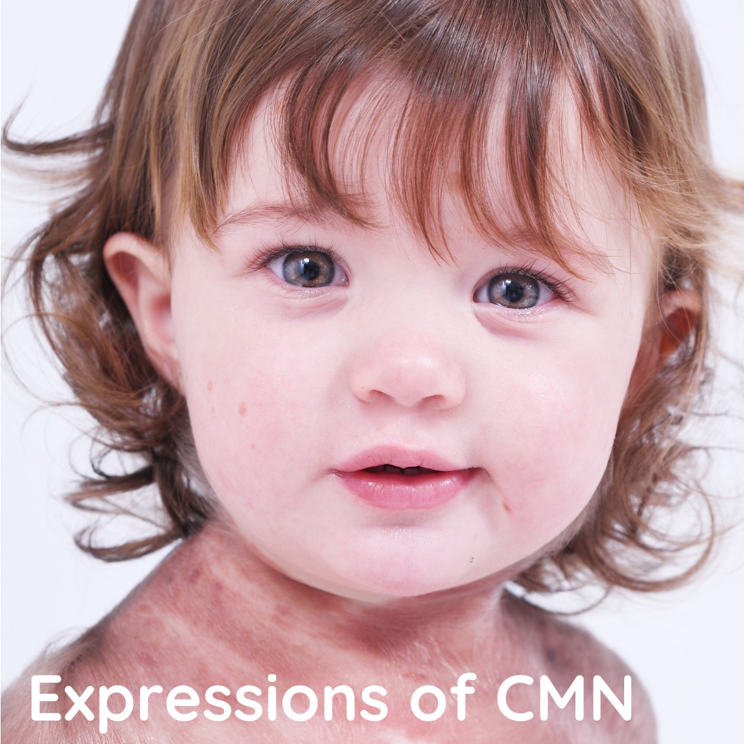 Do you know CMN has many different expressions?  Do you know CMN is now understood as a Mosaic Disorder?  This article explains the broad range of CMN expressions and their genetic causes: caringmattersnow.co.uk/expressions-of…