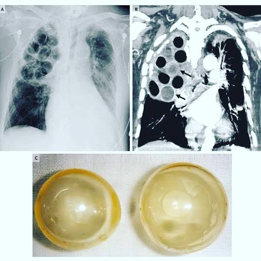 @modernHealthMe Plombage, also known as extraperiosteal or extrapleural pneumonolysis, is a historical treatment method for cavitary tuberculosis of the upper lobes of the lungs. It was used in the 1930s, 1940s, and 1950s prior to the introduction of effective antituberculous drugs, when