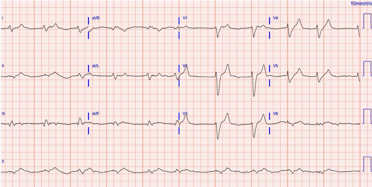 Handed this ECG from triage. What will you do? @PendellM hqmeded-ecg.blogspot.com/2024/05/handed…