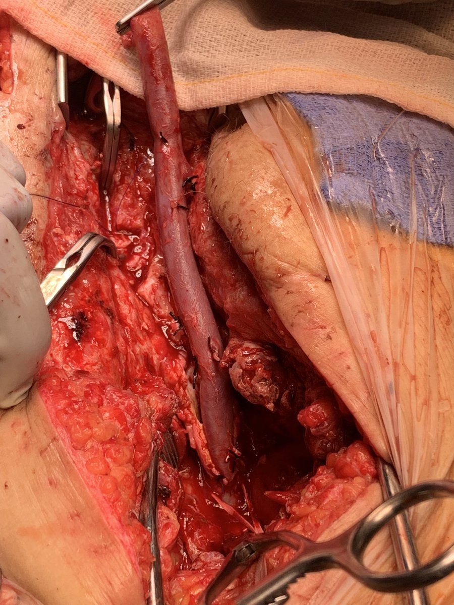 farkomd's tweet photo. The common femoral endarterectomy is a great operation. Until it’s not, and it relates to infection. Femoral Vein total reconstruction with reconstruction of profunda and SFA https://t.co/G7bX3dx3xP